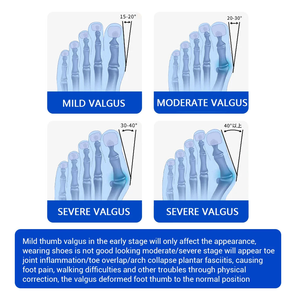 Moajaza Bunion Adjuster Knob Foot Brace For Hallux Valgus